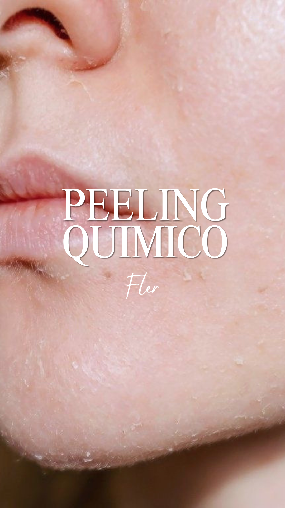 Peeling químico